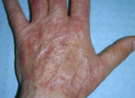 Эпидермофития рук