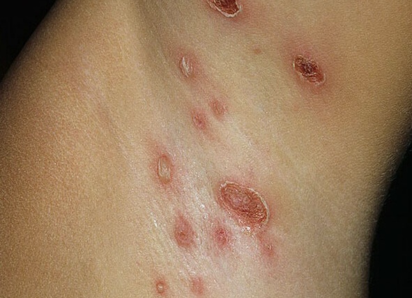 Стрептодермия под мышками