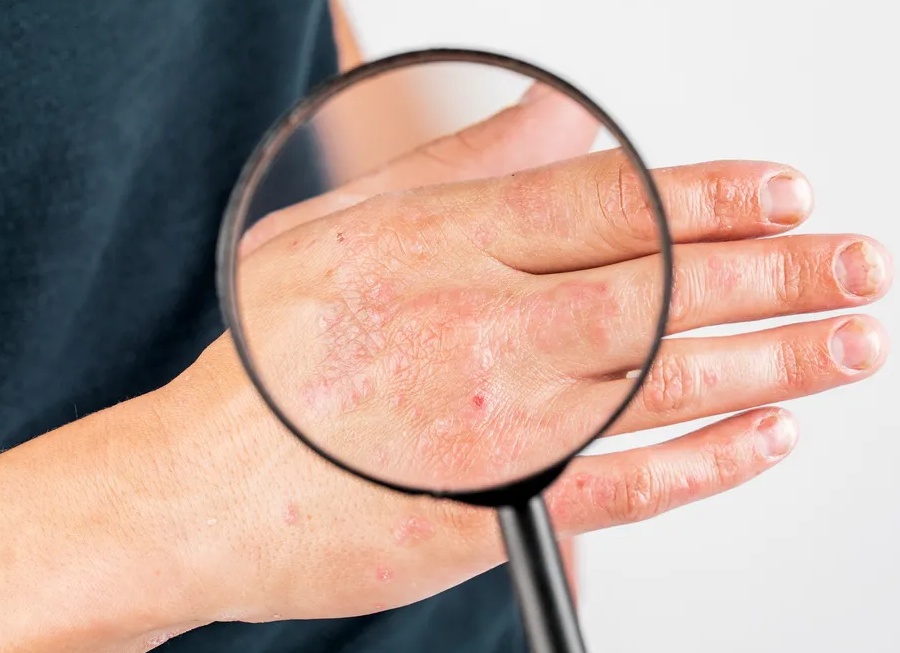 Профилактика нейродермита