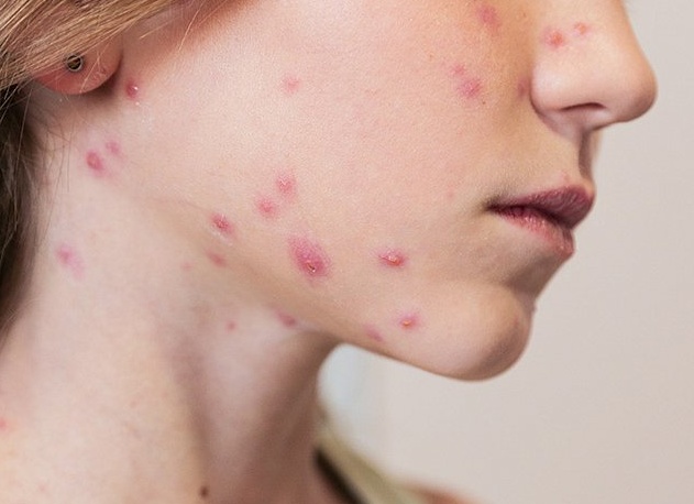 Можно ли заболеть ветрянкой во второй раз