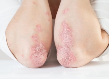 Как распознать первичные проявления псориаза?