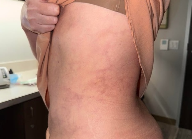 Лечение эритемы