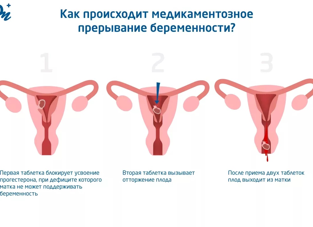 Как делают медикаментозный аборт и чем это опасно