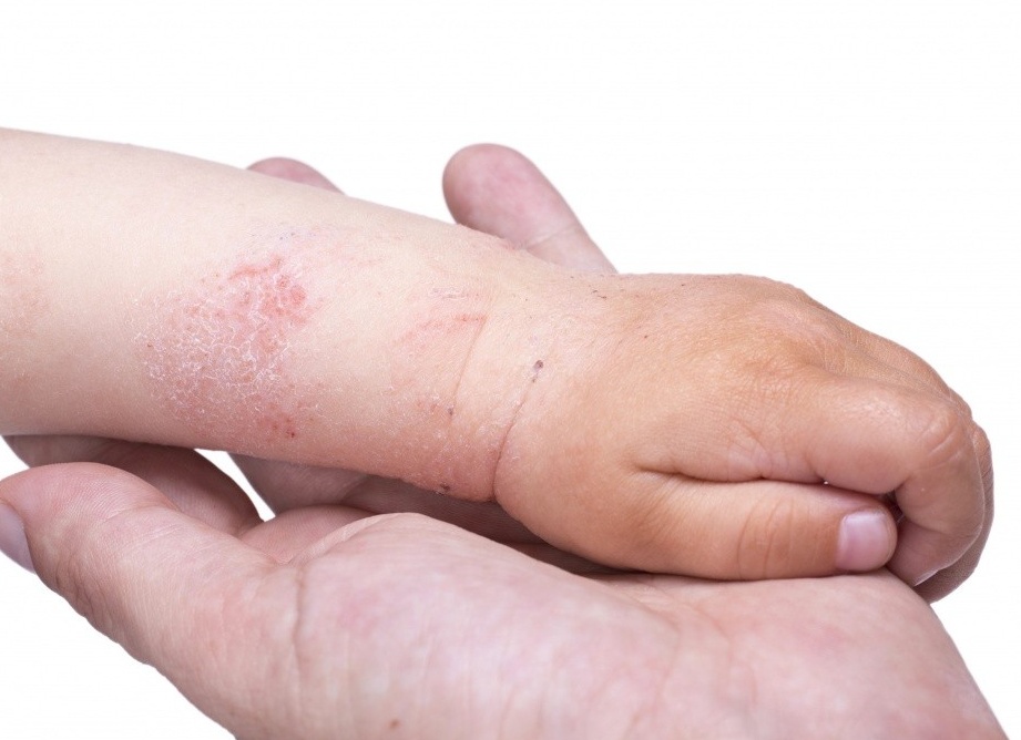 Экзема у детей