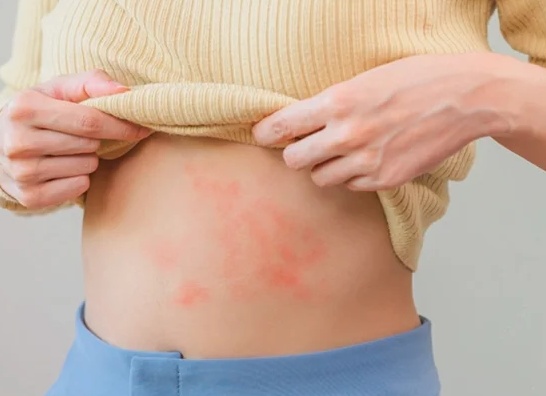 Сыпь на животе