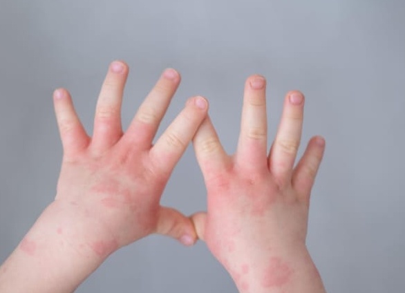 Эритразма у детей