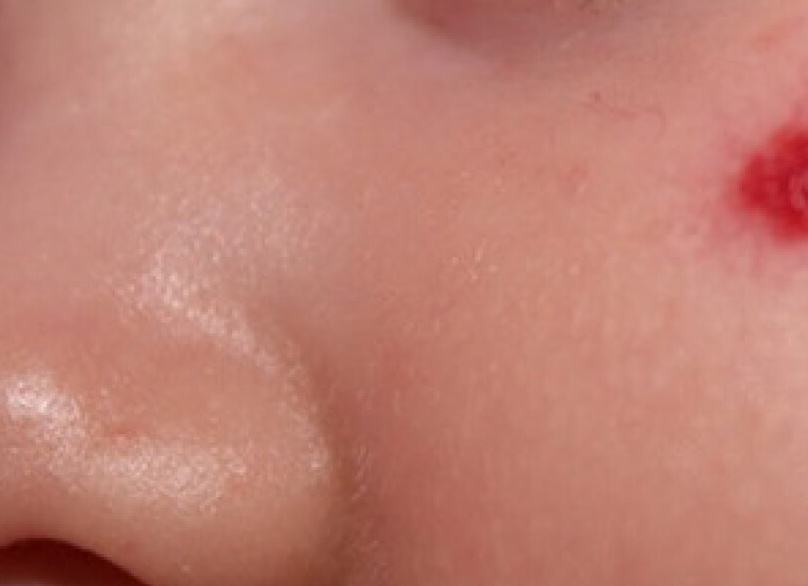 Красные пятна на коже