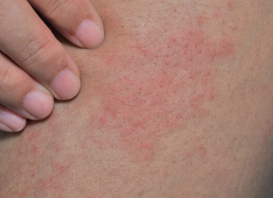 Кожный зуд при беременности