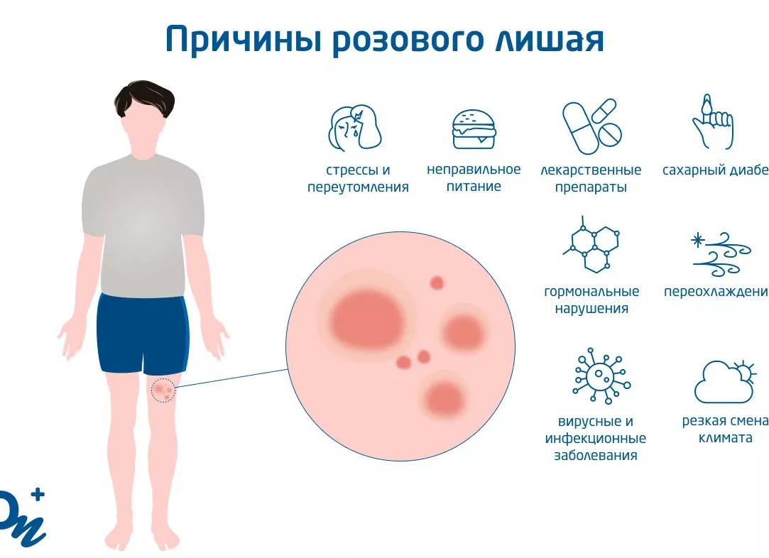 Лечение розового лишая