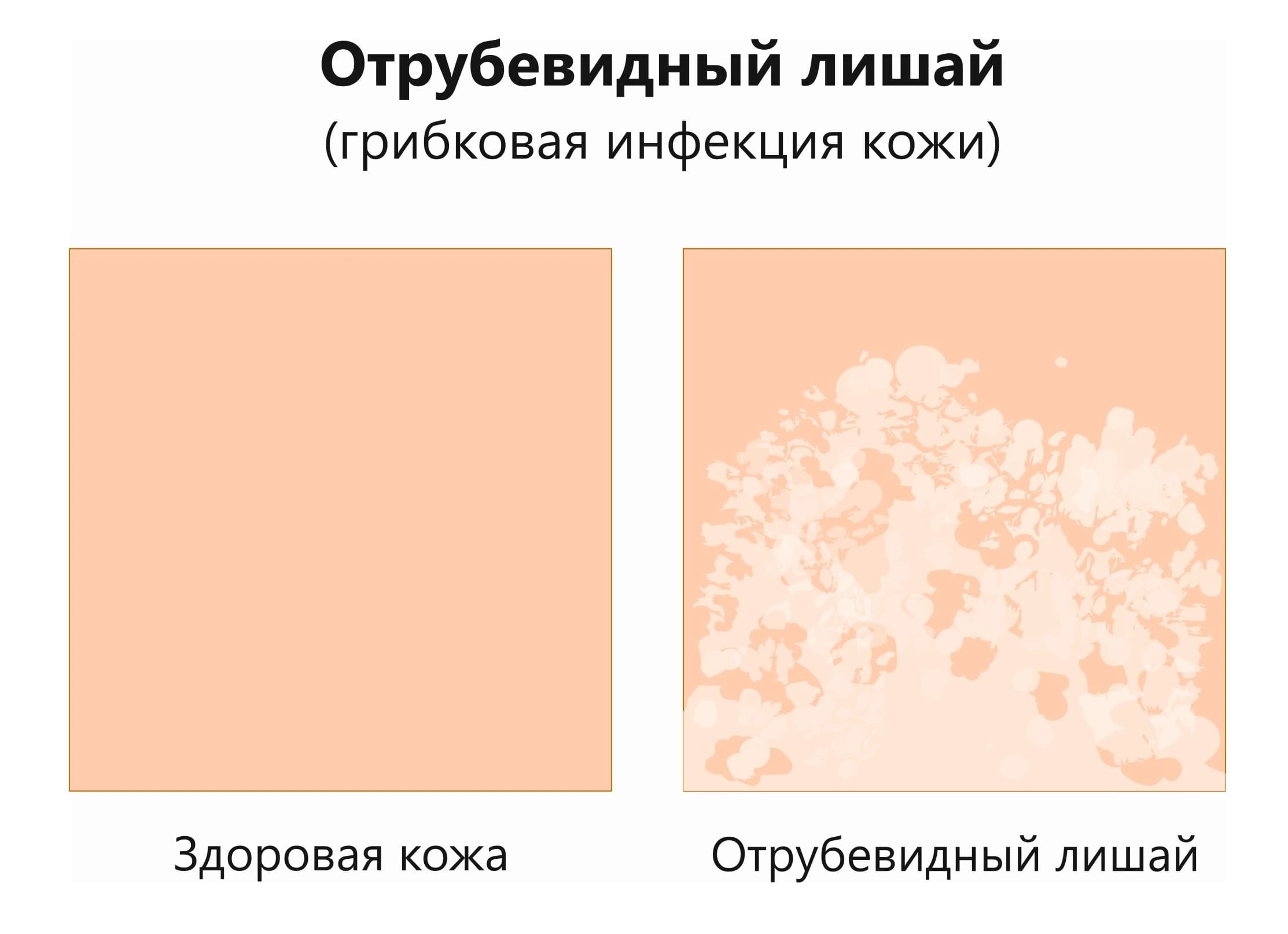 Откуда берется отрубевидный лишай