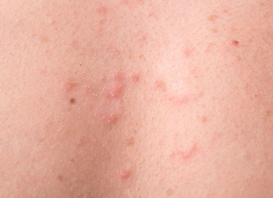 Симптомы стрептодермии