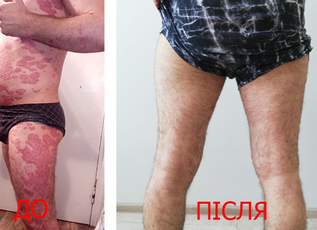 Какие причины вызывают псориаз?