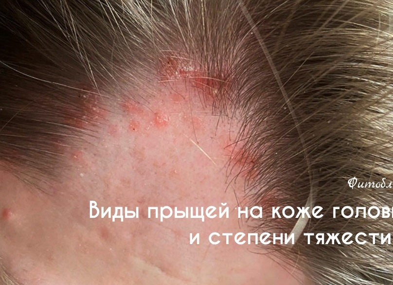 Сыпь на голове