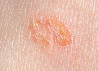 Стрептодермия у взрослых