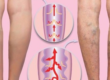 Профилактика варикоза: 12 привычек для здоровых вен