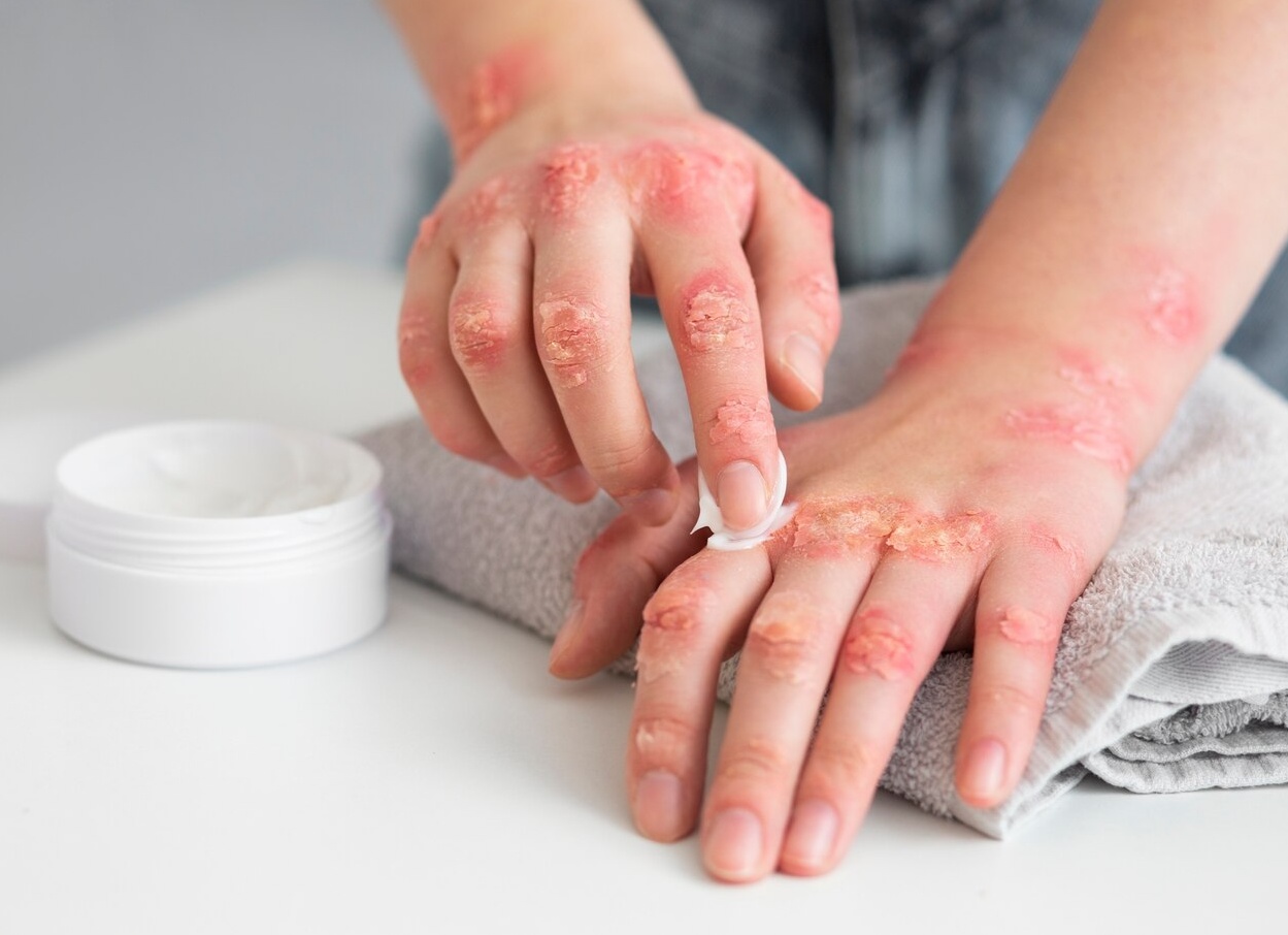 Экзема кистей рук