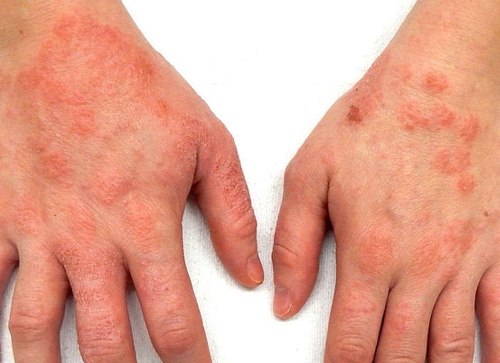 Экзема на руках