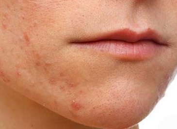 Экзема на лице