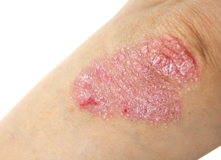 Лечение нейродермита