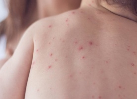 Пиодермия на теле