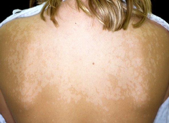 Пятна на коже спины