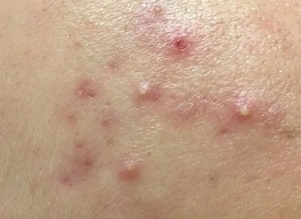 Лечение пиодермии