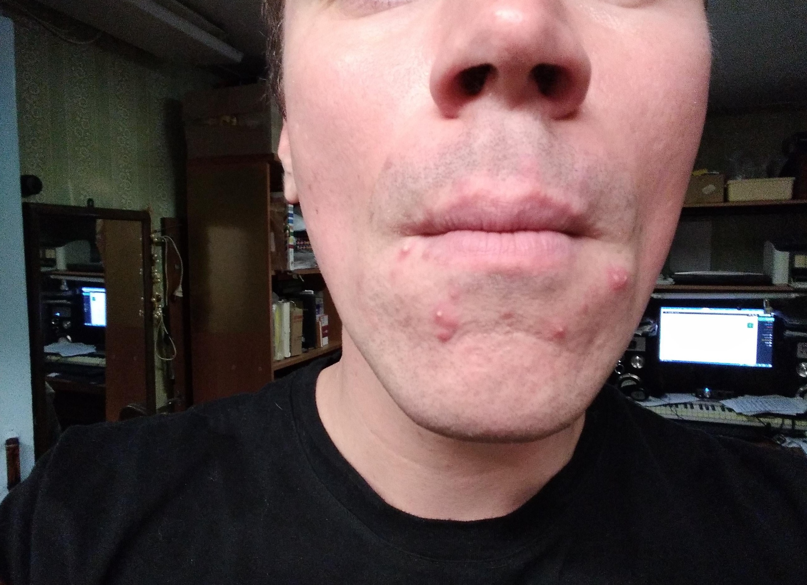 Эритема у мужчин