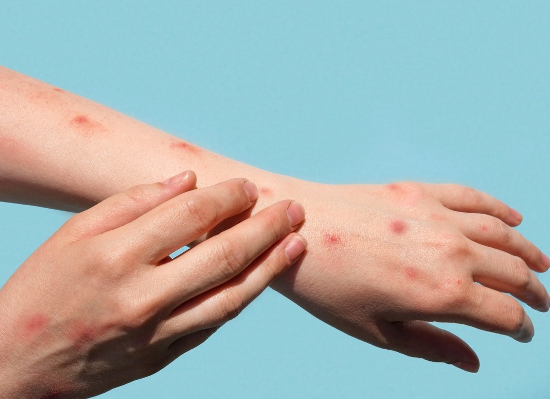 Пиодермия на руках
