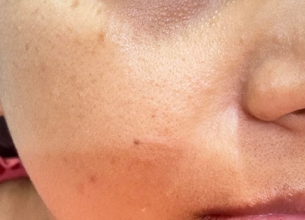 Пятна на коже появляются, когда мне жарко или душно