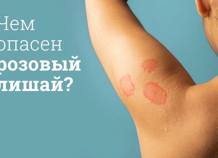 Розовый лишай у взрослых