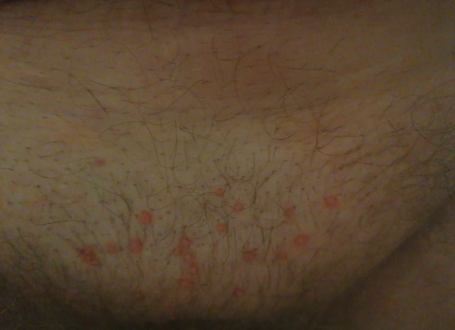 Сыпь в паху