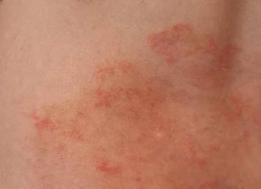 Симптомы микоза