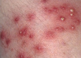 Стафилодермия у детей