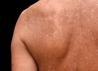 Почему появляется отрубевидный лишай