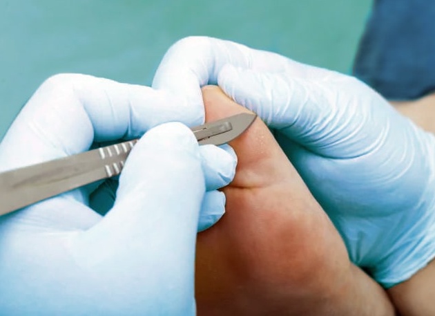 Диагностика микоза