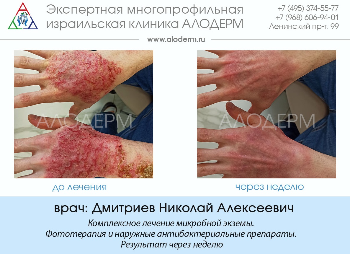 Диагностика экземы