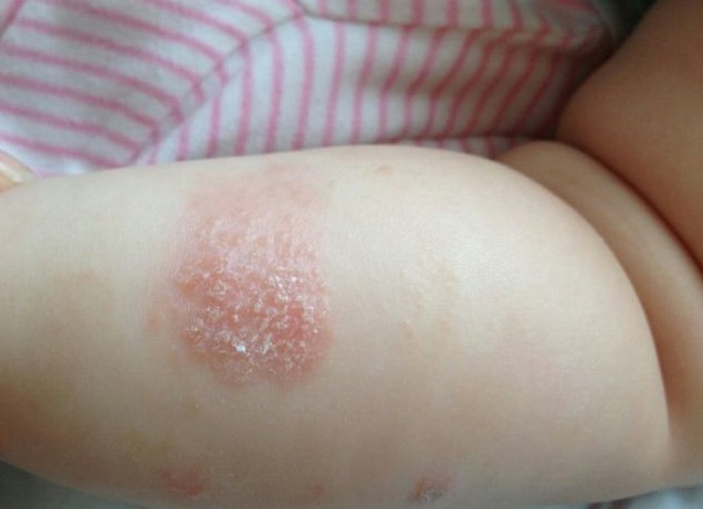 Шелушение кожи у ребенка