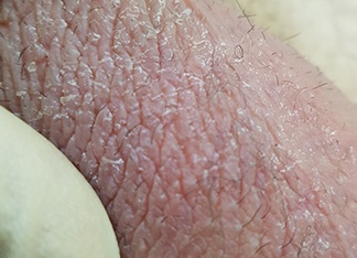 Чешется мошонка