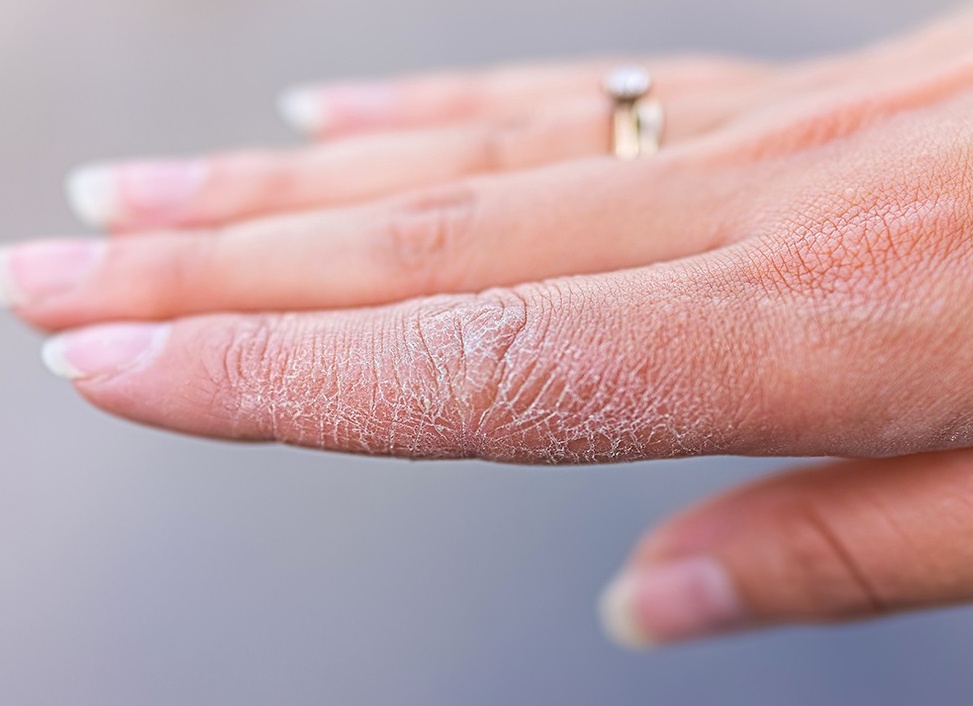 Шелушение кожи на руках
