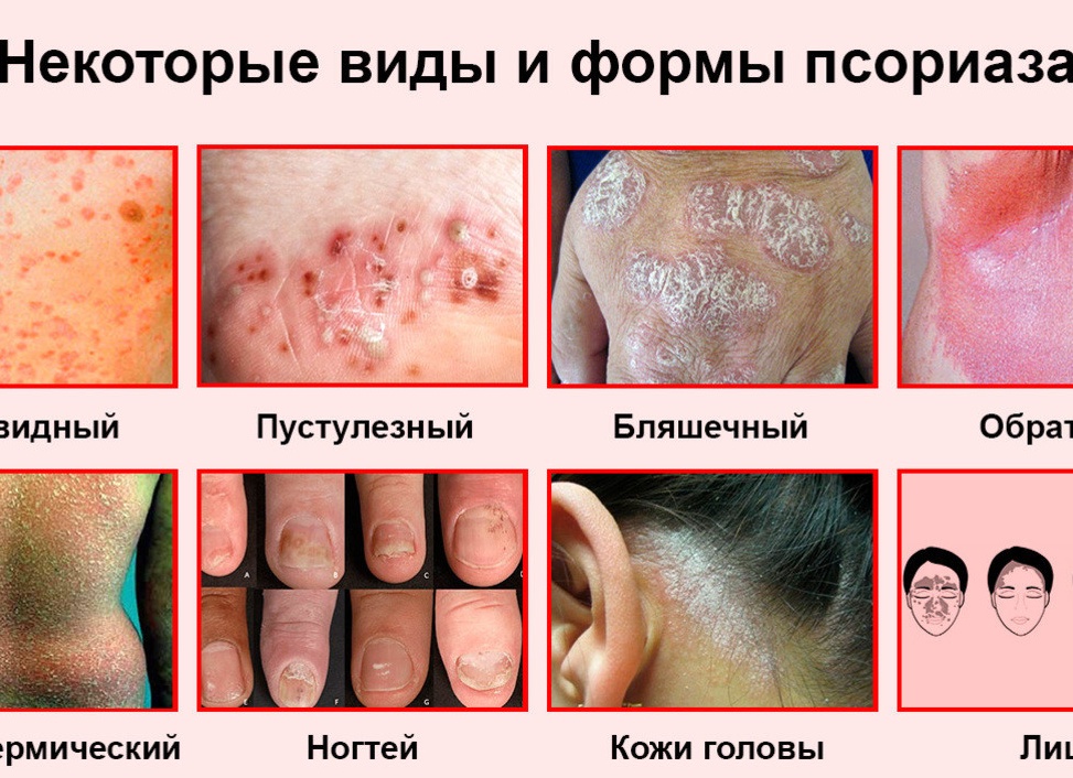 Какие формы псориаза существуют и как часто они встречаются?