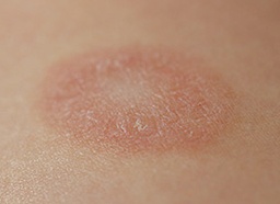 Розовый лишай у детей