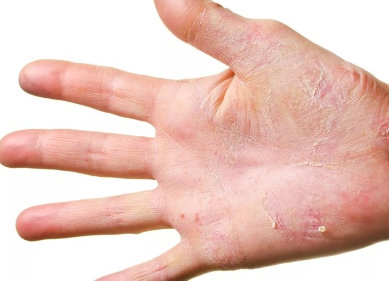 Сухая экзема