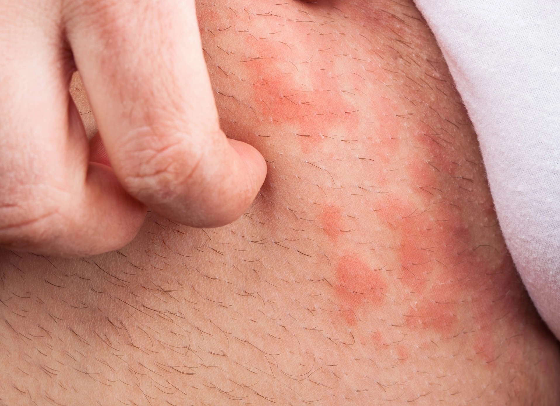 Эпидермофития у мужчин