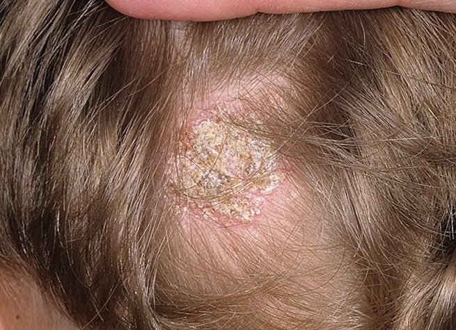 Нейродермит на голове
