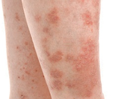 Кожный зуд на ногах