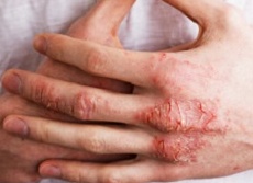 Трескается кожа на руках