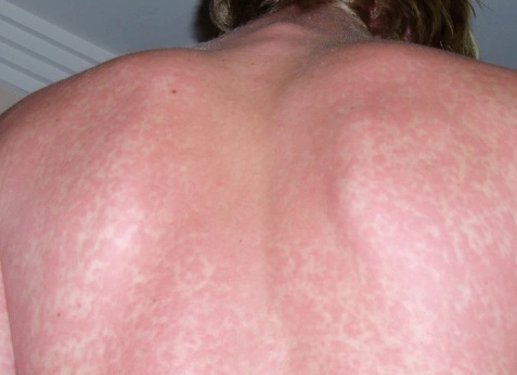 Причины возникновения сыпи