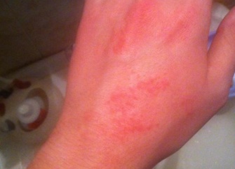 Кожный зуд у взрослых