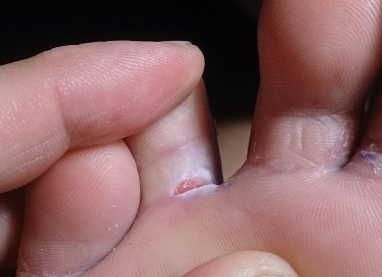 Треснула кожа между пальцами