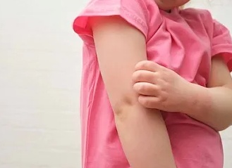 А является ли стафилодермия заразной?